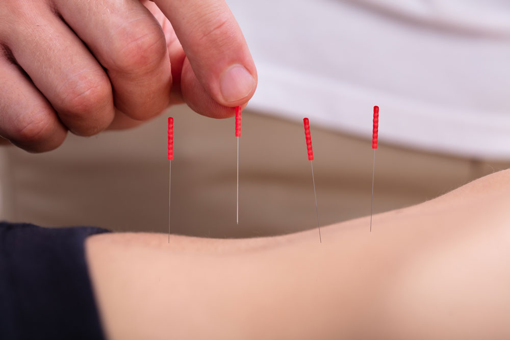 acupuncture